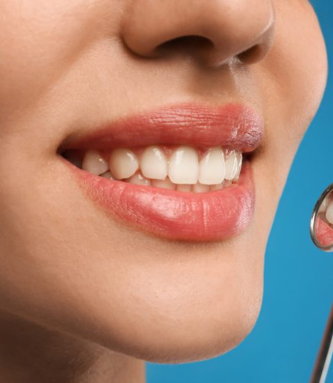 sbiancamento_dentale